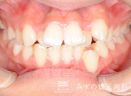 前歯のガタガタ 症例