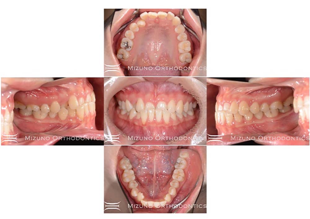 インビザライン 症例画像