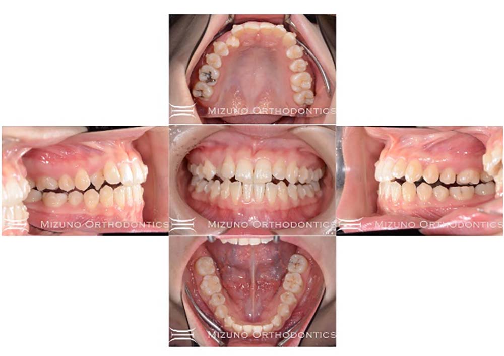 インビザライン 症例画像