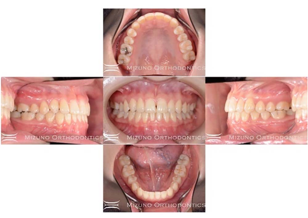 インビザライン 症例画像