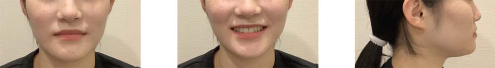 インビザライン 症例画像