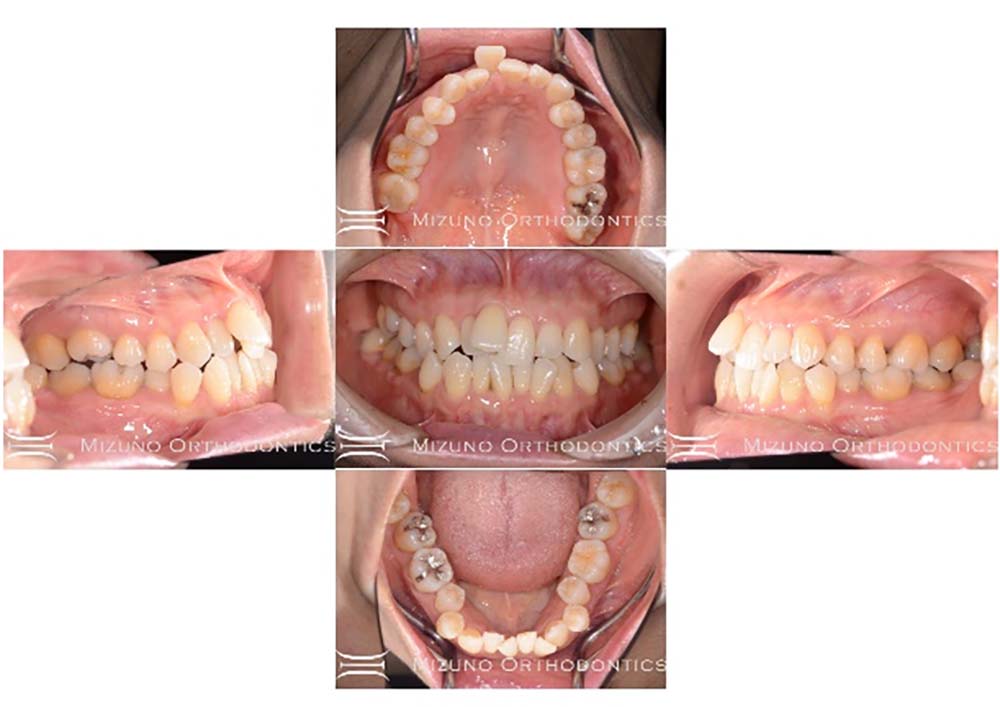 インビザライン 症例画像