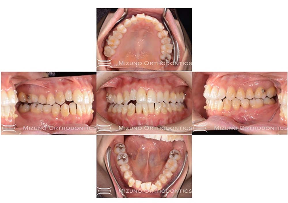インビザライン 症例画像