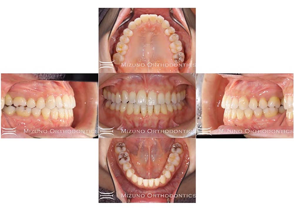 インビザライン 症例画像