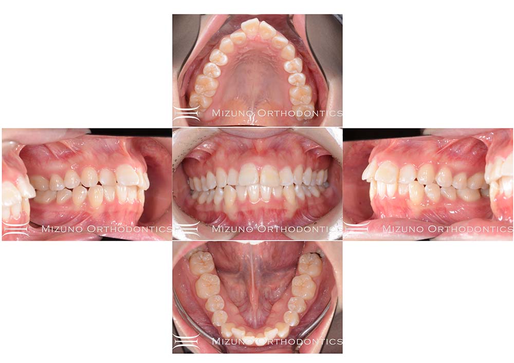 インビザライン 症例画像