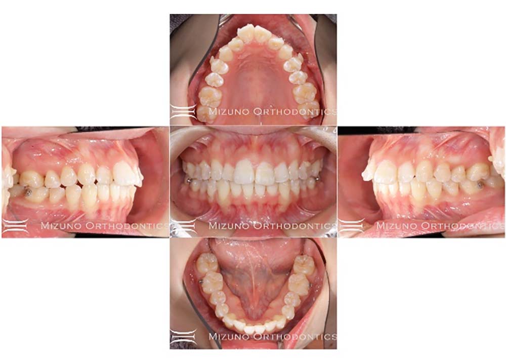 インビザライン 症例画像