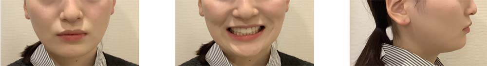 インビザライン 症例画像