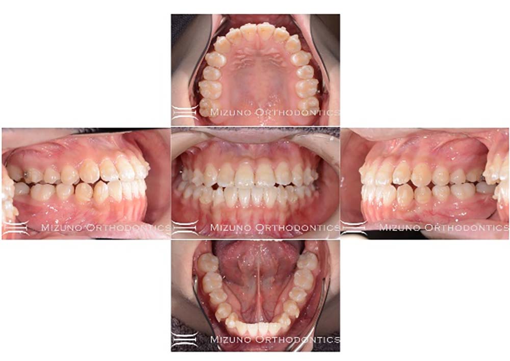 インビザライン 症例画像