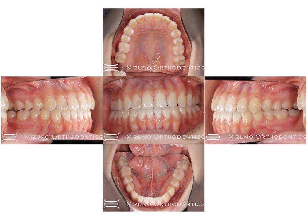 インビザライン 症例画像