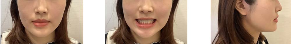 インビザライン 症例画像