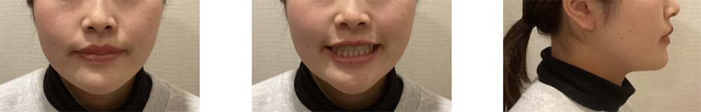 インビザライン 症例画像