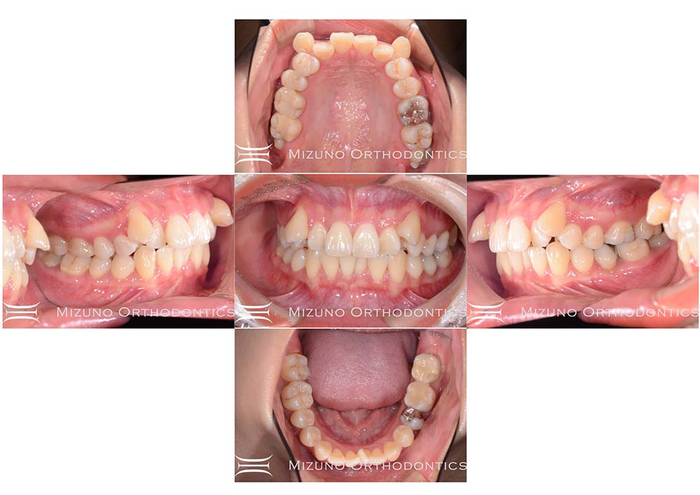 インビザライン 症例画像