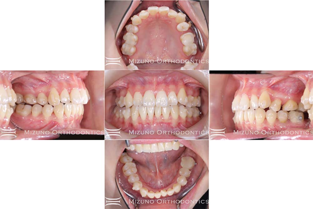 インビザライン 症例画像