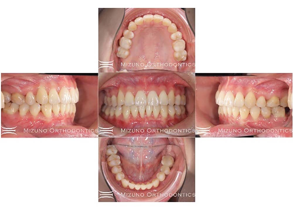 インビザライン 症例画像