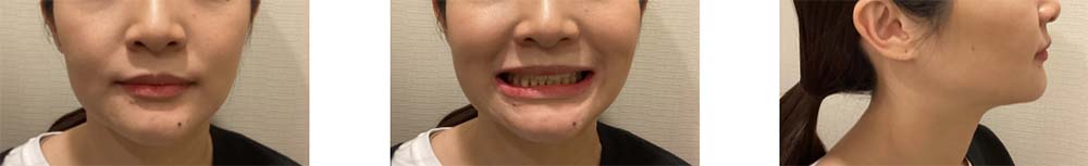 インビザライン 症例画像