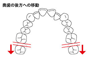 奥歯の後方への移動