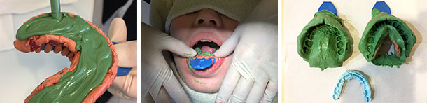 マウスピース矯正