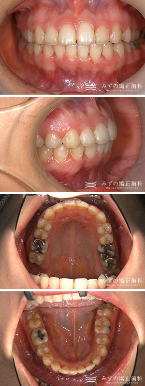 非抜歯 症例画像