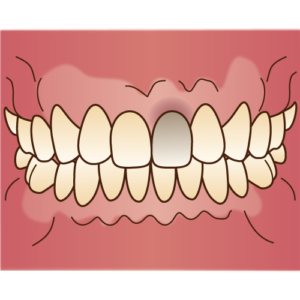 アンキローシス(骨性癒着)