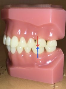 正常咬合顎模型