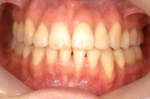 ブラックトライアングル