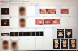 矯正治療前精密検査データ