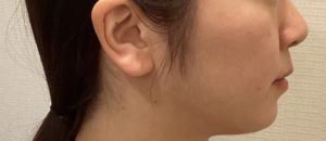 矯正治療後口元