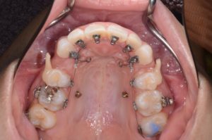 フルリンガルブラケット