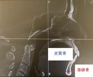 皮質骨　海綿骨