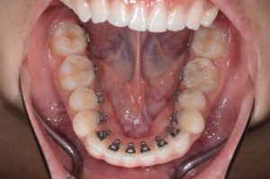 フルリンガルブラケット　