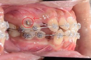 アンカースクリュー、抜歯