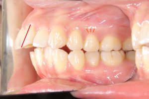 上顎前突　抜歯症例