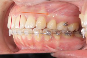 上顎前突　抜歯症例